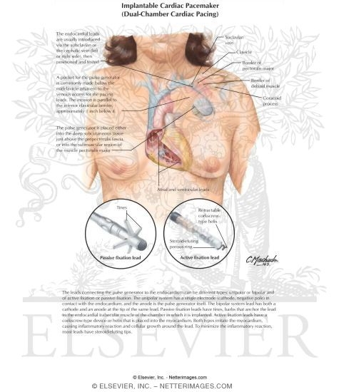 Implantable Cardiac Pacemaker (Dual-Chamber Cardiac Pacing)
