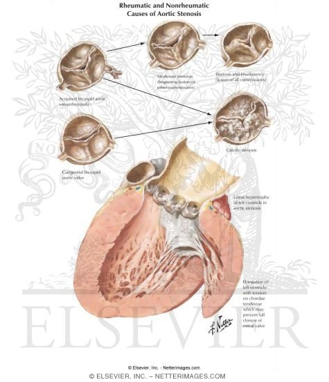 Rheumatic Heart Disease X - Aortic Stenosis
Rheumatic and Nonrheumatic Causes of Aortic Stenosis