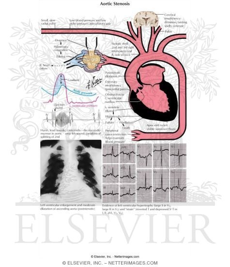 Watermarked preview of labeled image: Aortic Stenosis