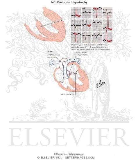 Watermarked preview of labeled image: Left Ventricular Hypertrophy