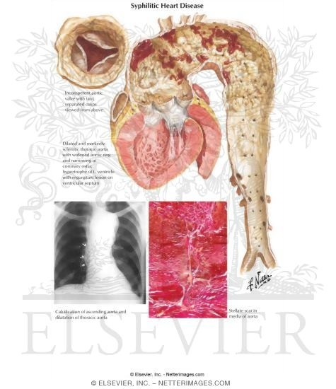 Syphilitic Heart Disease