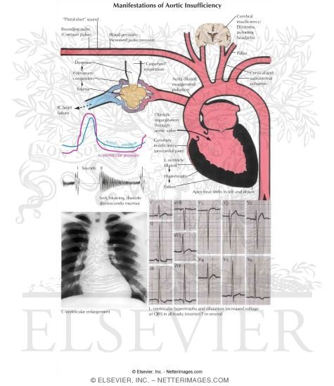 Aortic Insufficiency
Manifestations of Aortic Insufficiency
Valvular Stenosis and Insufficiency