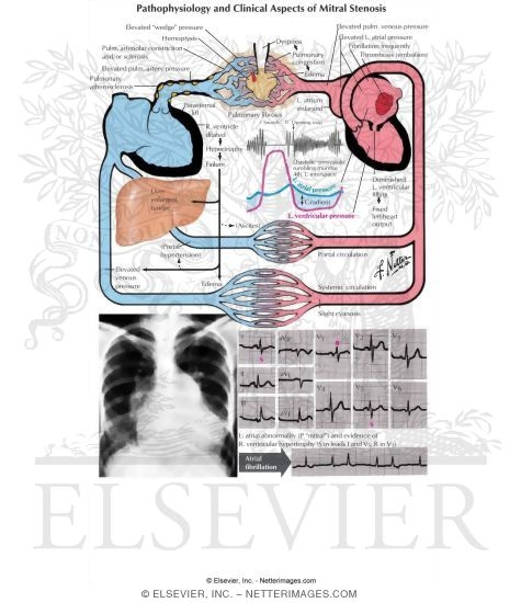 Pathophysiology and Clinical Aspects of Mitral Stenosis