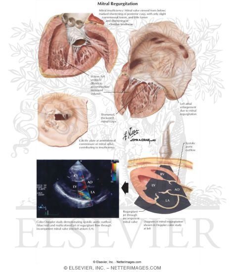 Watermarked preview of labeled image: Mitral Regurgitation
