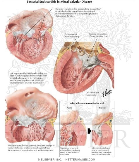 Bacterial Endocarditis in Mitral Valvular Disease