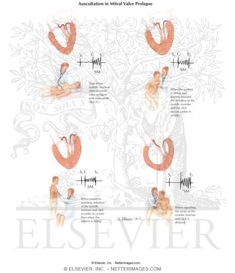 Auscultation in Mitral Valve Prolapse