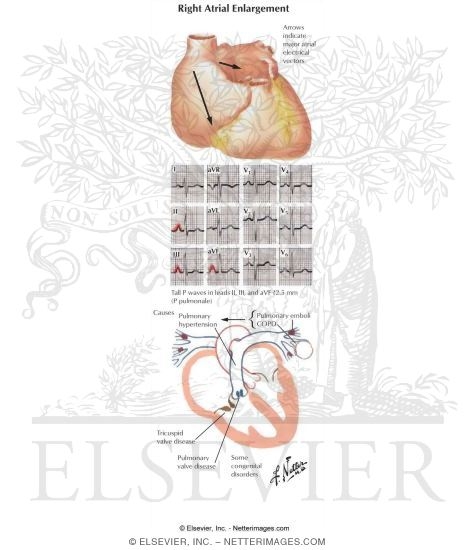 Right Atrial Enlargement