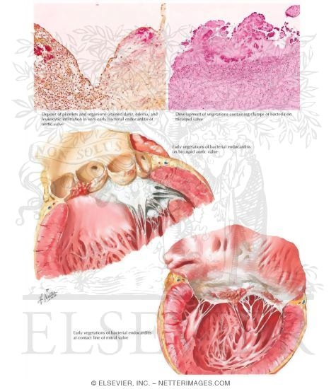 Bacterial Endocarditis - Early Lesions