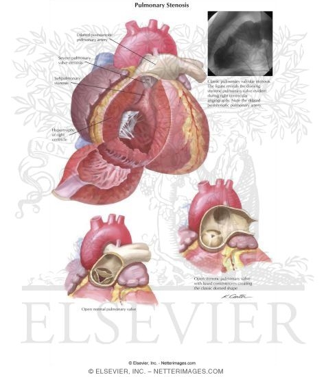 Watermarked preview of labeled image: Pulmonary Stenosis