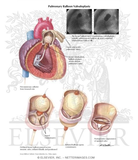 Watermarked preview of labeled image: Pulmonary Balloon Valvuloplasty