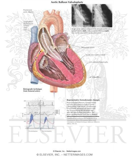 Aortic Balloon Valvuloplasty