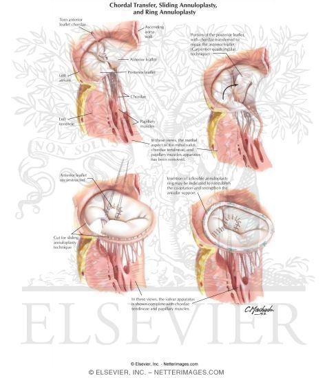 Watermarked preview of labeled image: Chordal Transfer, Sliding Annuloplasty, and Ring Annuloplasty
