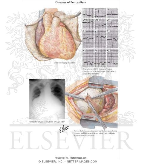 Diseases of Pericardium