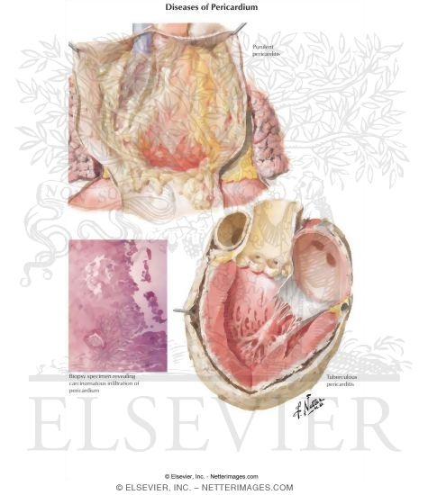 Watermarked preview of labeled image: Diseases of Pericardium
