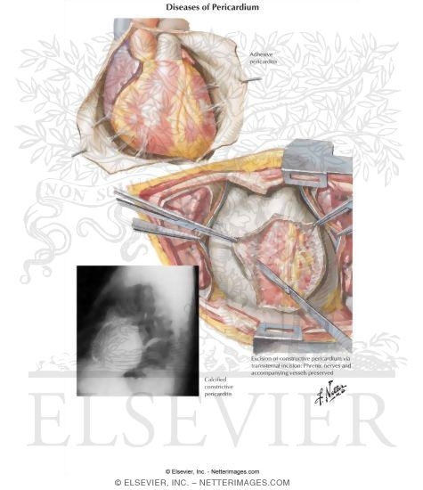 Watermarked preview of labeled image: Diseases of Pericardium