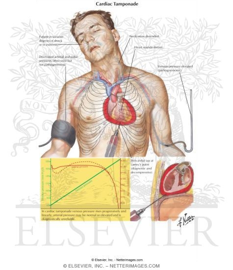 Watermarked preview of labeled image: Right Atrium and Ventricle
