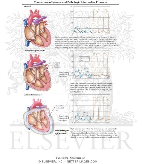 Watermarked preview of labeled image: Comparison of Normal and Pathologic Intracardiac Pressures