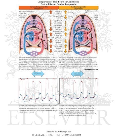 Normal Cardiac Blood Flow During Inspiration and Expiration