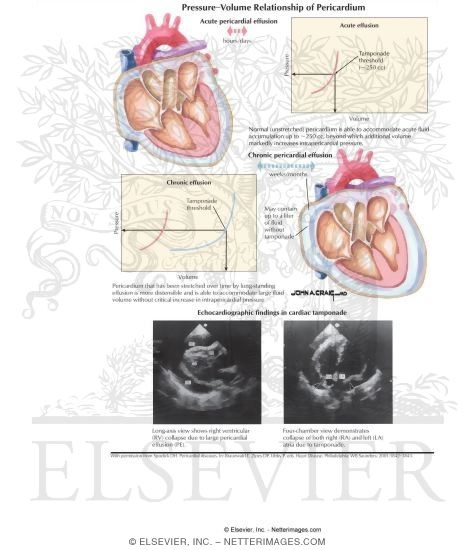 Watermarked preview of labeled image: Pressure: Volume Relationship of Pericardium