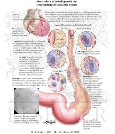 Watermarked preview of labeled image: Mechanisms of Arteriogenesis and Development of Collateral Vessels