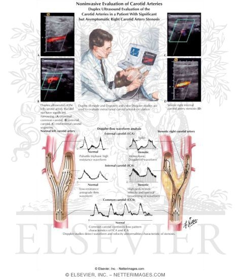 Watermarked preview of labeled image: Noninvasive Evaluation of Carotid Arteries