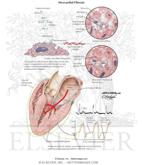 Watermarked preview of labeled image: Myocardial Fibrosis