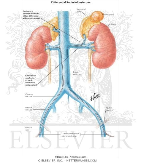 Watermarked preview of labeled image: Differential Renin and Aldosterone