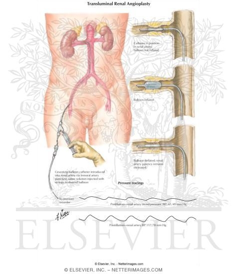 Transluminal Renal Angioplasty