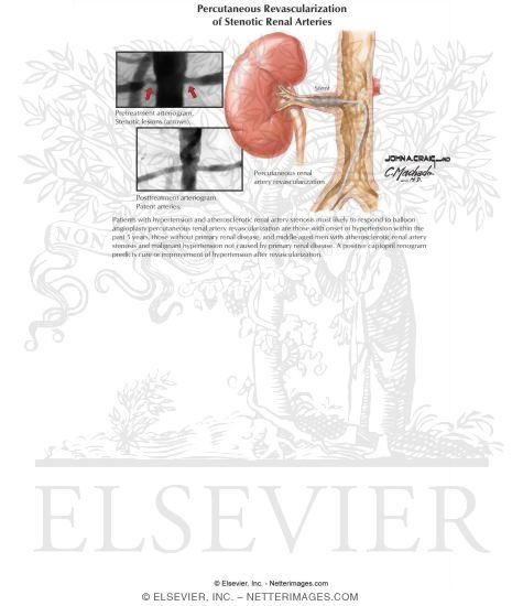 Watermarked preview of labeled image: Percutaneous Revascularization of Stenotic Renal Arteries
