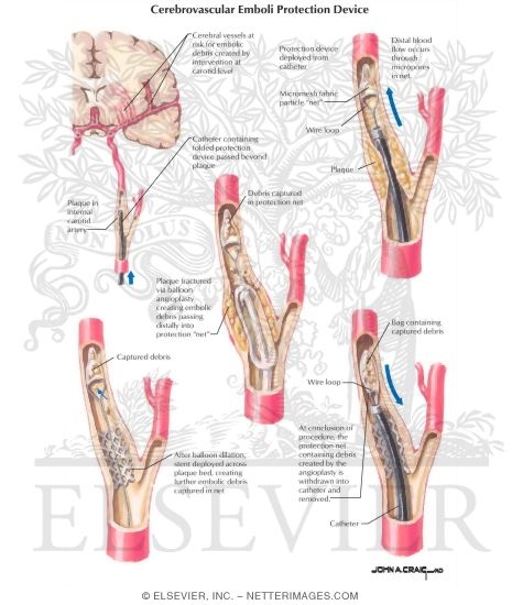 Watermarked preview of labeled image: Cerebrovascular Emboli Protection Device