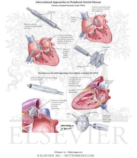 Watermarked preview of labeled image: Interventional Approaches to Peripheral Arterial Disease