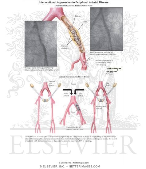 Watermarked preview of labeled image: Interventional Approaches to Peripheral Arterial Disease