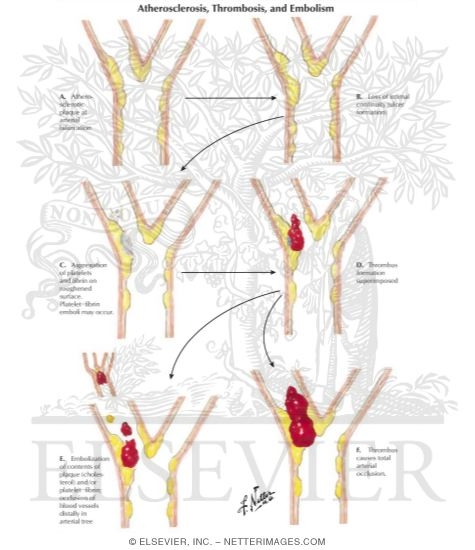Watermarked preview of labeled image: Atherosclerosis, Thrombosis, and Embolism