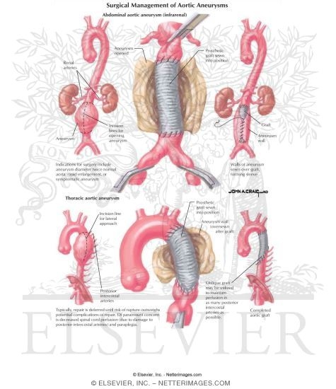 Watermarked preview of labeled image: Surgical Management of Aortic Aneurysms