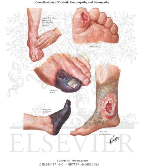 Vascular Insufficiency In Diabetes
Complications of Diabetic Vasculopathy and Neuropathy