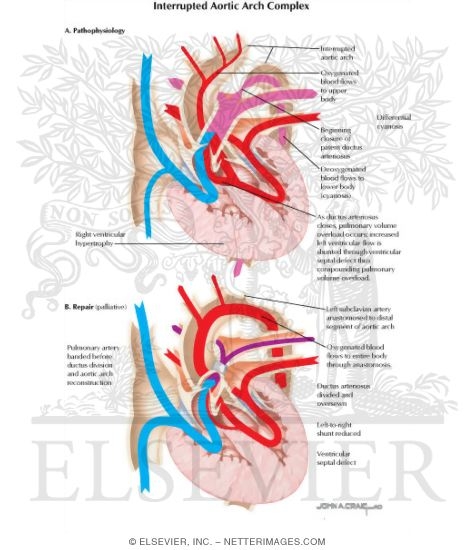Watermarked preview of labeled image: Interrupted Aortic Arch Complex