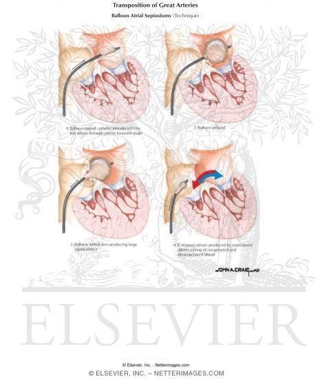 Watermarked preview of labeled image: Transposition of Great Arteries