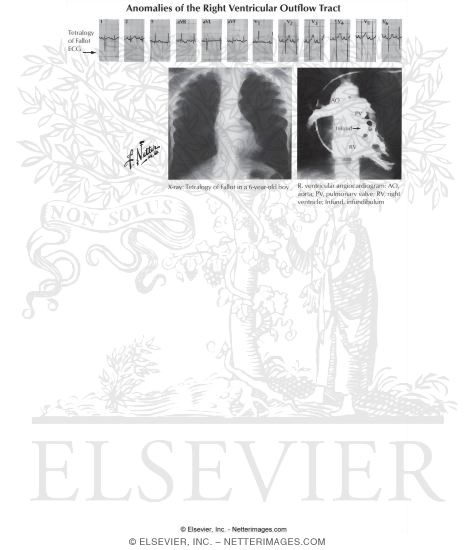 Watermarked preview of labeled image: Anomalies of the Ventricular Septum