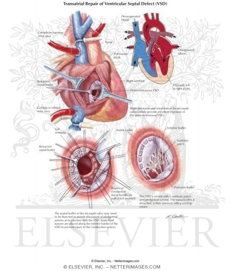 Watermarked preview of labeled image: Transatrial Repair of Ventricular Septal Defect (VSD)