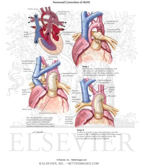 Watermarked preview of labeled image: Norwood Correction of HLHS