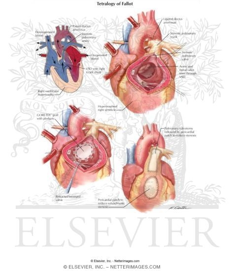Watermarked preview of labeled image: Tetralogy of Fallot