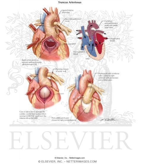 Watermarked preview of labeled image: Arterial Repair of Transposition of the Great Arteries