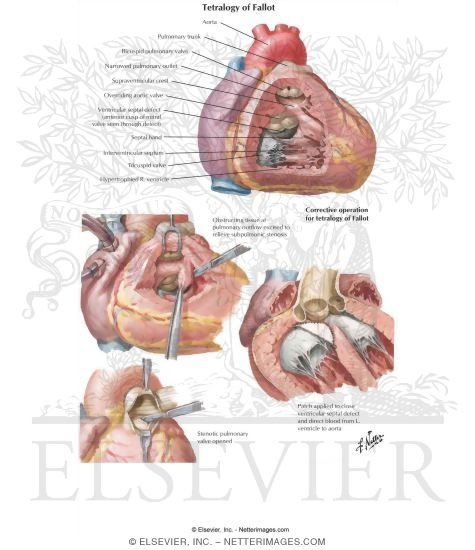 Watermarked preview of labeled image: Tetralogy of Fallot