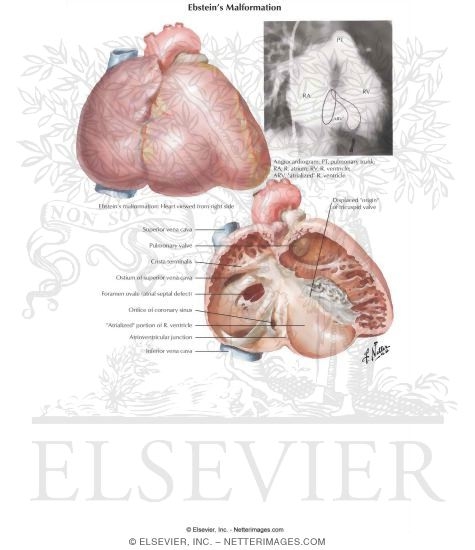 Watermarked preview of labeled image: Anomalies of the Tricuspid Valve
Ebstein's Malformation