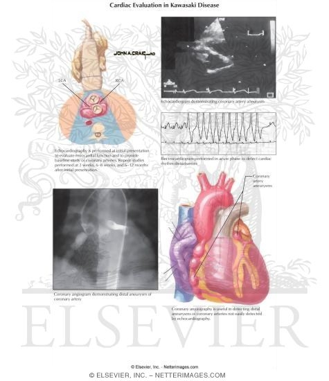 Watermarked preview of labeled image: Cardiac Evaluation in Kawasaki Disease