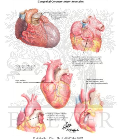 Watermarked preview of labeled image: Congenital Coronary Artery Anomalies