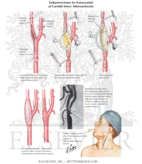 Endarterectomy for Extracranial of Carotid Artery Atherosclerosis