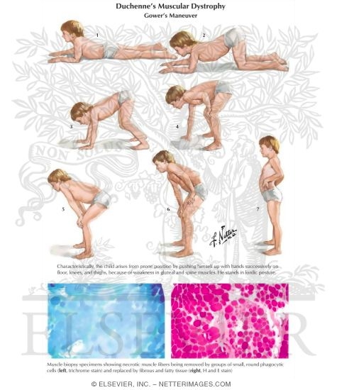 Duchenne's Muscular Dystrophy