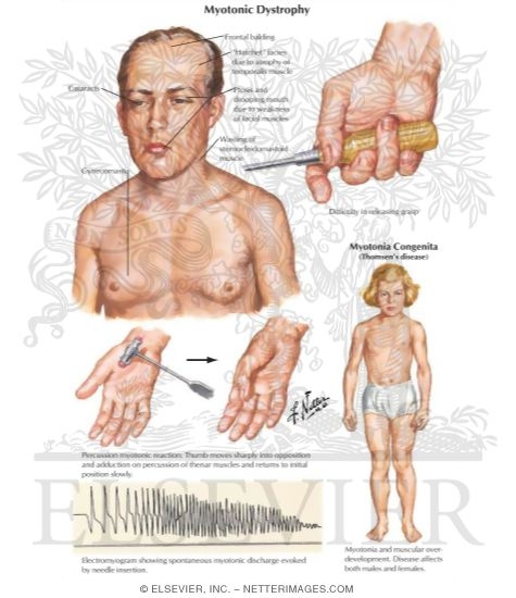 Myotonic Dystrophy