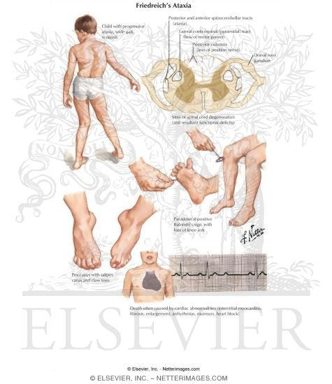 Ataxia-Telangiectasia: Background, Pathophysiology ...